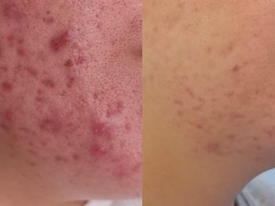 acne (1)