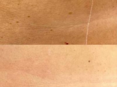 keratosis + kersenangioma