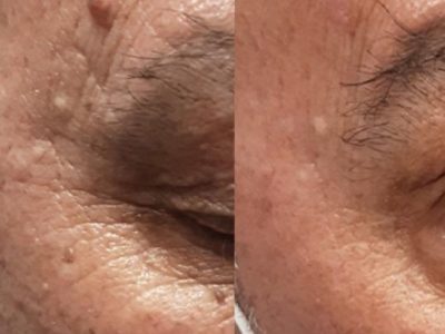 nevus